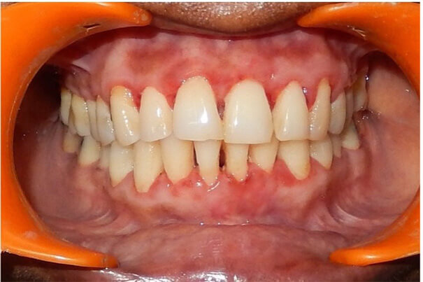 After gingival enlargement